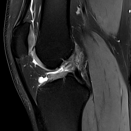 Dorsal defect of patella | Radiology Case | Radiopaedia.org