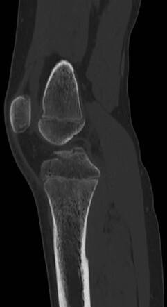 Tibial eminence avulsion fracture - Meyers and McKeever type 3b | Image ...