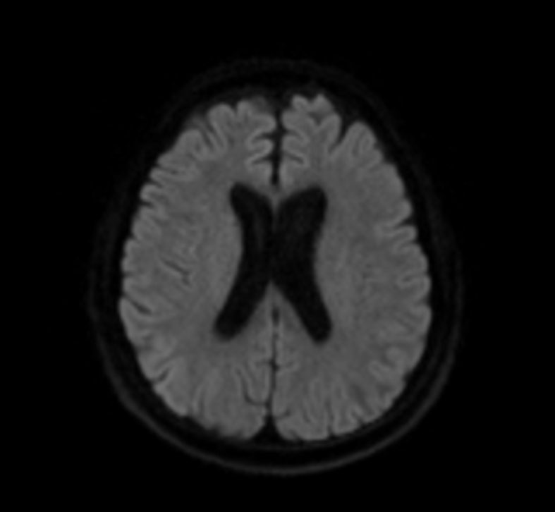 Amyloid-related Imaging Abnormalities (ARIA) | Image | Radiopaedia.org