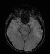 Inflammatory Cerebral Amyloid Angiopathy | Radiology Reference Article ...