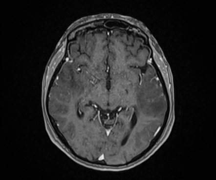 Amyloid-related Imaging Abnormalities (ARIA) | Image | Radiopaedia.org