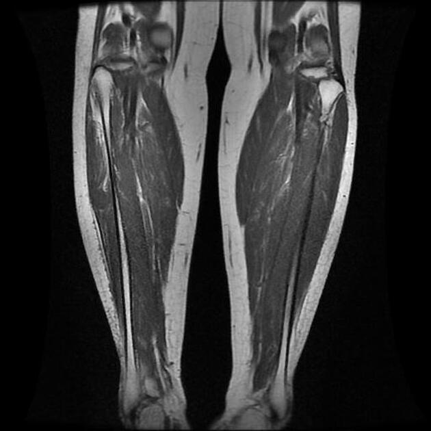 Peripheral nerve sheath tumor, Radiology Reference Article