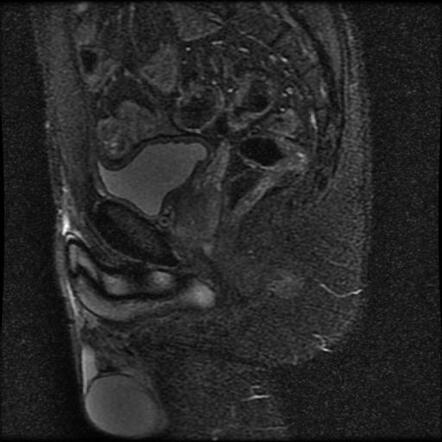 Intersphincteric perianal fistula | Radiology Case | Radiopaedia.org