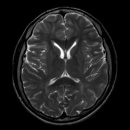 Mitochondrial neurogastrointestinal encephalomyopathy syndrome | Image ...