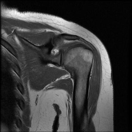 Acromial fracture | Image | Radiopaedia.org