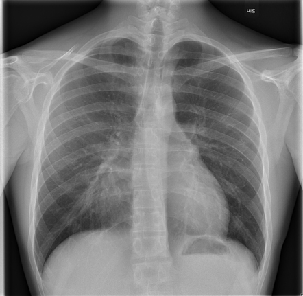 Pectus excavatum | Radiology Case | Radiopaedia.org