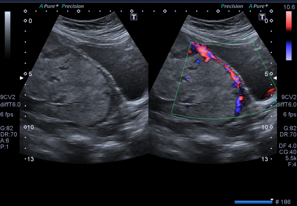 Placenta Accreta Image