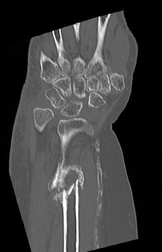 Galeazzi Fracture Dislocation Chronic Image Radiopaedia Org