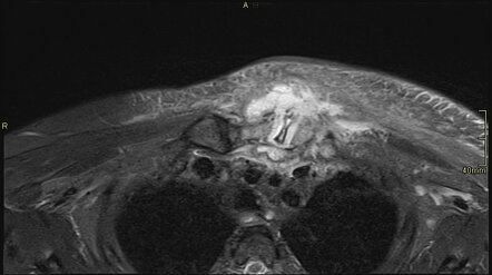 Sternoclavicular joint septic arthritis | Radiology Case | Radiopaedia.org