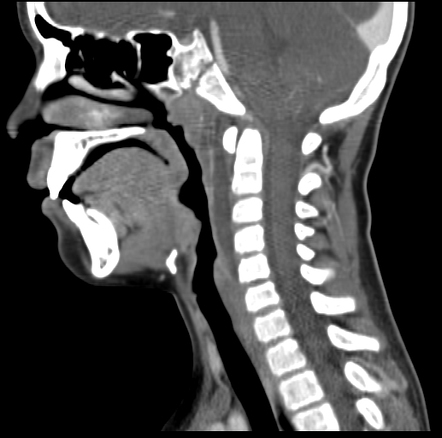 Retropharyngeal abscess | Radiology Case | Radiopaedia.org