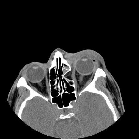 Blow-out Fracture Of The Orbital Medial Wall | Radiology Case ...