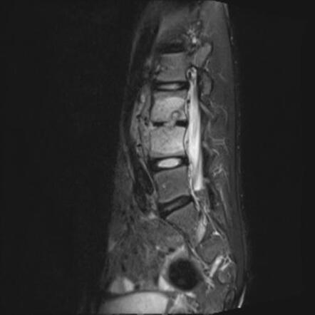 Tuberculous Spondylodiscitis | Radiology Case | Radiopaedia.org