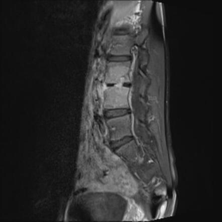 Tuberculous Spondylodiscitis | Image | Radiopaedia.org