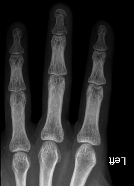 Comminuted fracture of the distal phalanx Radiology Case