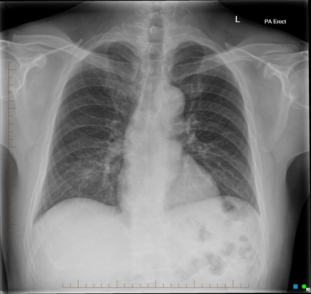 Coracoclavicular joint | Radiology Reference Article | Radiopaedia.org