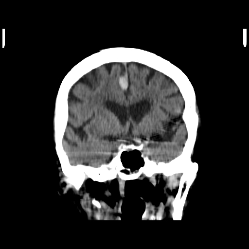 Interhemispheric subdural hemorrhage | Image | Radiopaedia.org