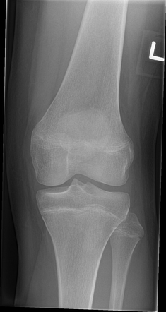 Osteoid osteoma - patella | Radiology Case | Radiopaedia.org