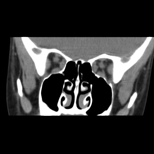 Dermoid Cyst In The Medial Canthus Image 8740