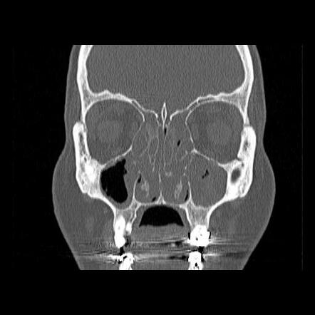 Sinonasal polyposis | Radiology Case | Radiopaedia.org