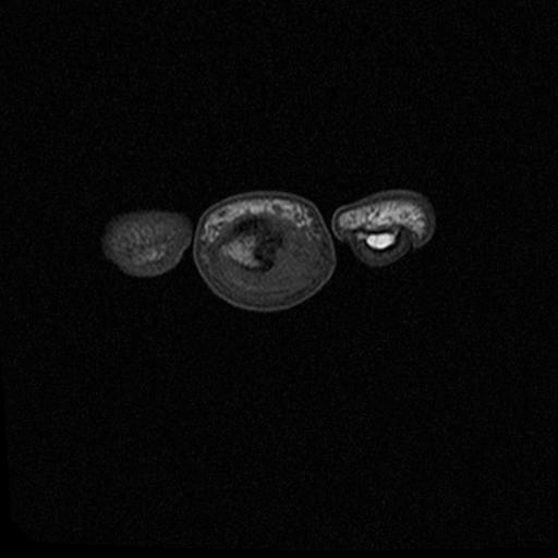 Juxta-cortical chondroma | Image | Radiopaedia.org