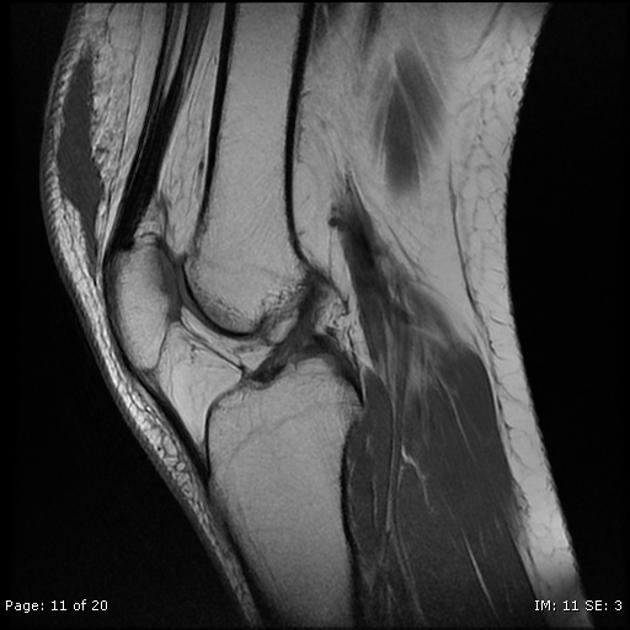 Morel Lavall e lesion of the knee Radiology Case Radiopaedia