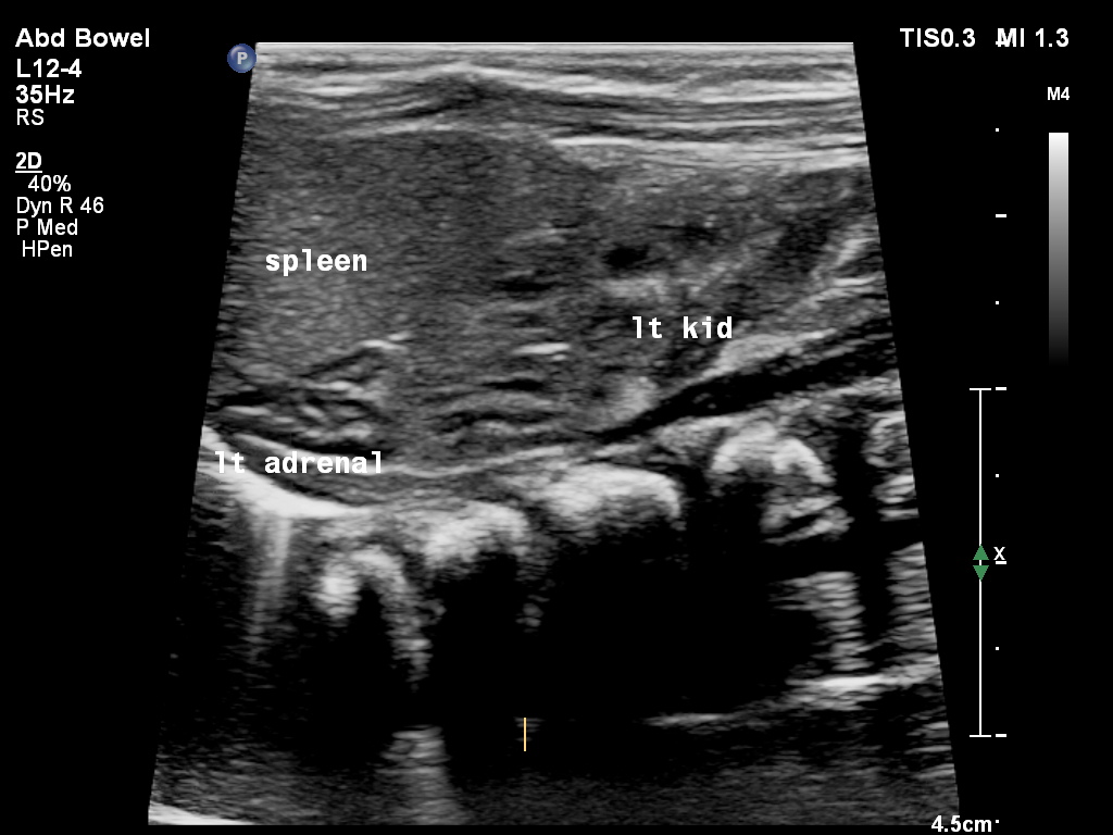 Normal Adrenal Glands Neonatal Ultrasound Image 6287