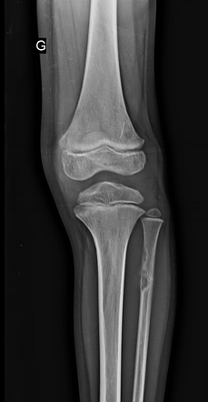 Pathological fracture - non-ossifying fibroma | Radiology Case ...