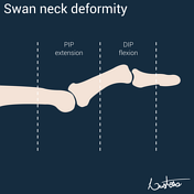 Swan neck deformity (fingers) | Radiology Reference Article ...