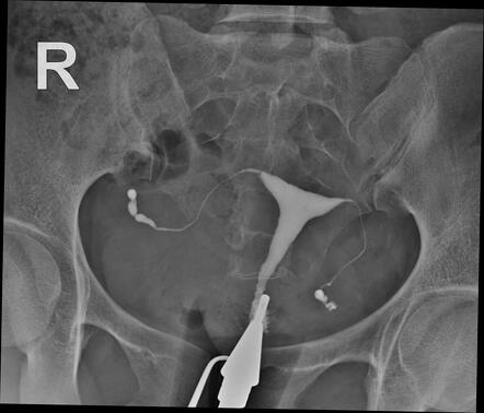 Right tubal block and hydrosalpinx | Radiology Case | Radiopaedia.org