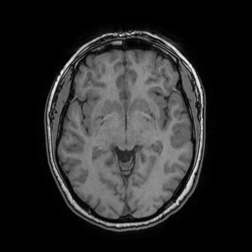 Acoustic neuroma Image