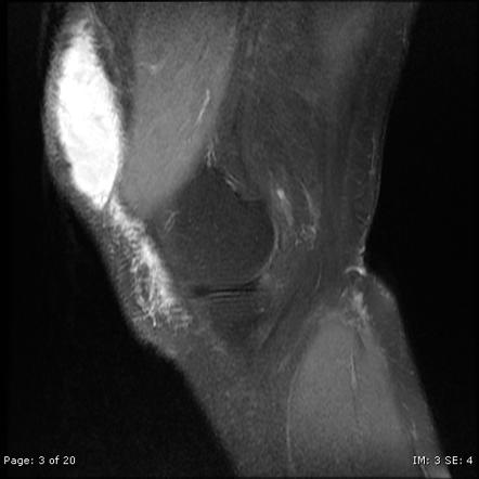 Morel Lavall e lesion of the knee Radiology Case Radiopaedia