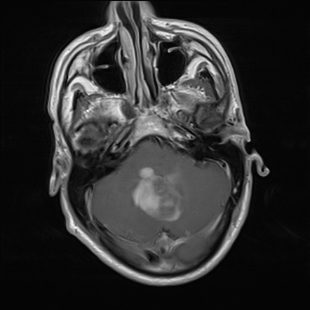 Diffuse astrocytoma NOS in the cerebellum | Image | Radiopaedia.org