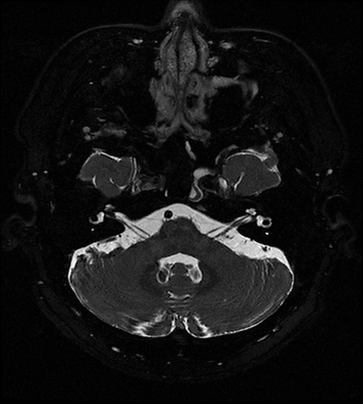 Intracanalicular vestibular schwannoma | Image | Radiopaedia.org