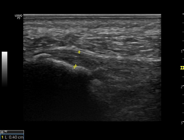 Plantar deals fasciitis radiopaedia