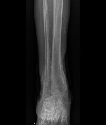 Chronic venous insufficiency | Radiology Reference Article ...