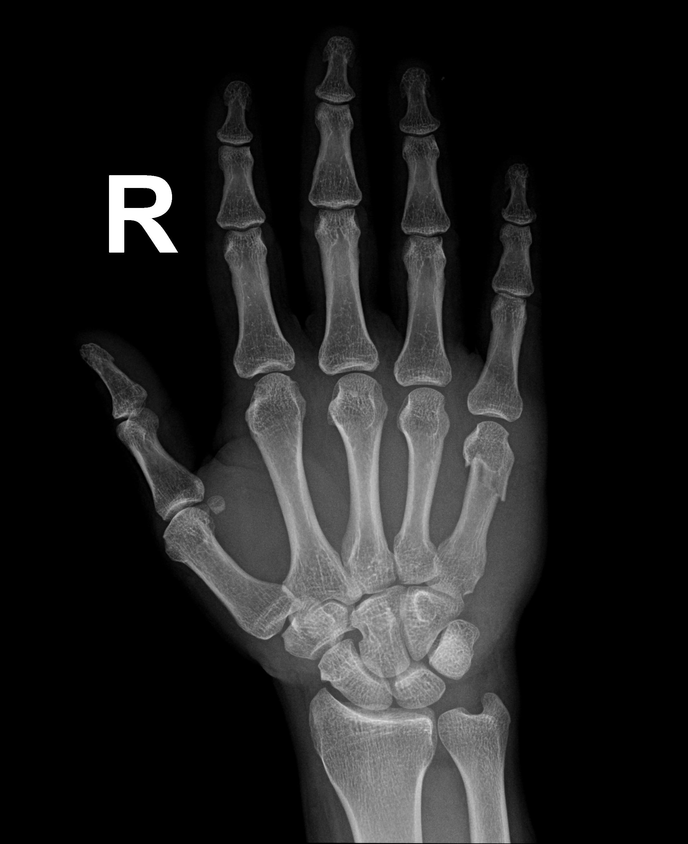 Boxer Fracture Image Radiopaedia Org