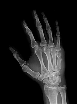 Boxer fracture | Image | Radiopaedia.org