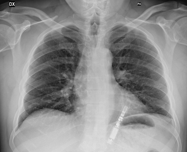 Vaping e cigarette device on chest radiograph Radiology Case