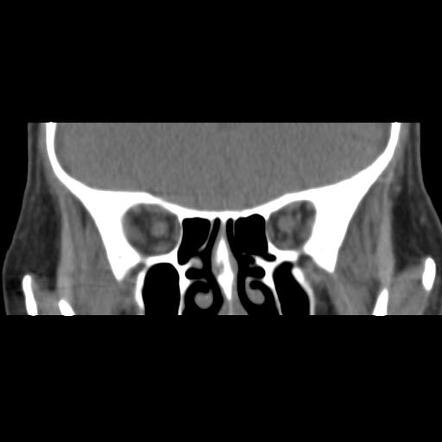 Ocular globe rupture | Image | Radiopaedia.org