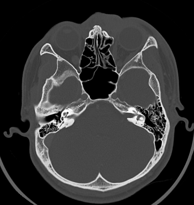 Dacryocystitis Image