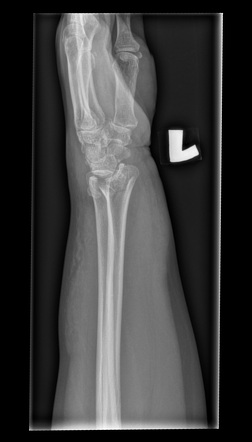 Diagram Shows The Frykman Classification Of Distal Ra - vrogue.co