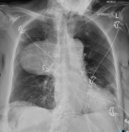 Thoracic aortic aneurysm | Radiology Case | Radiopaedia.org