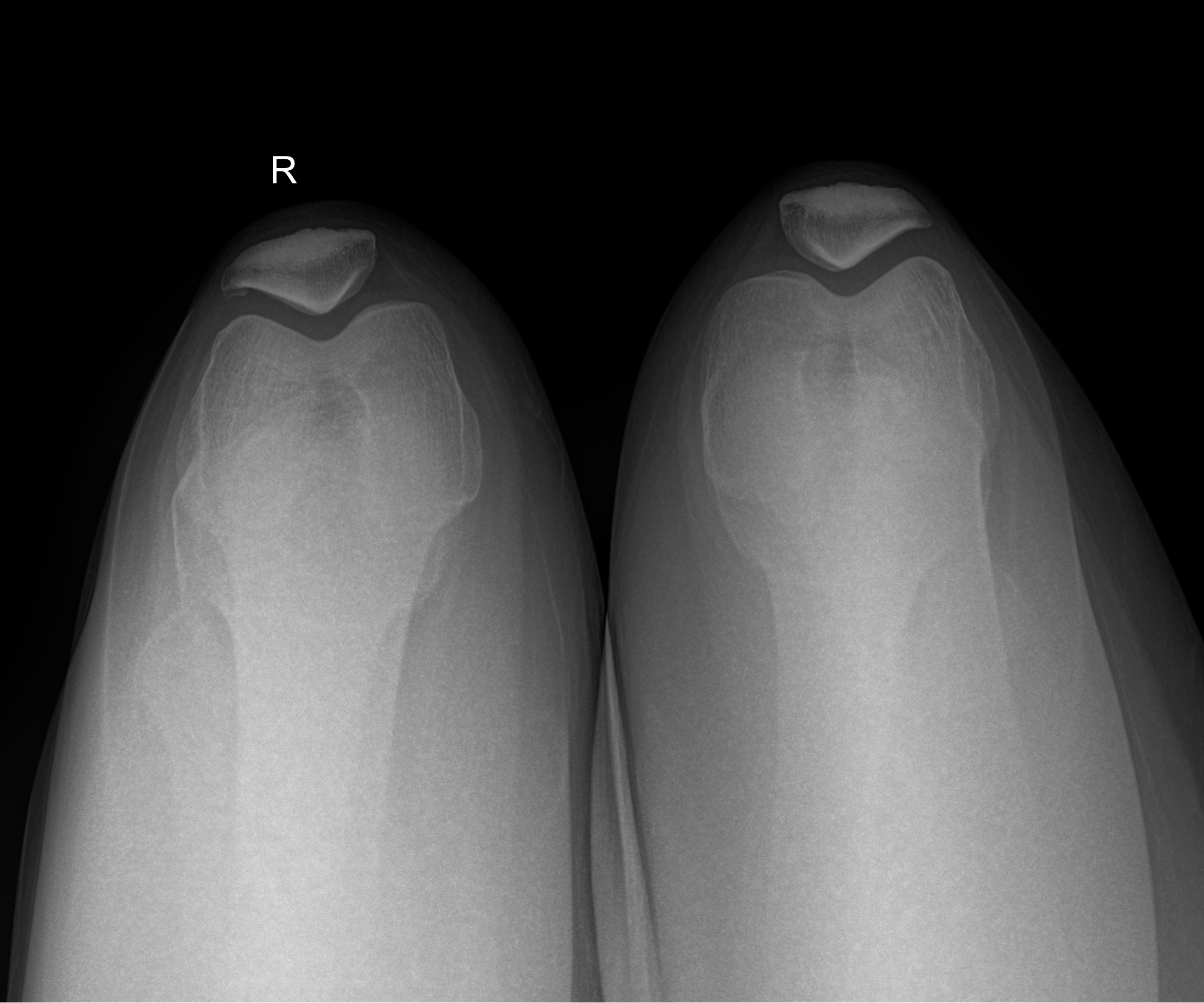 Bipartite patella | Image | Radiopaedia.org