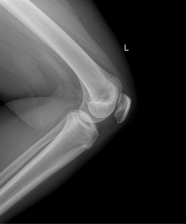 Bipartite patella | Image | Radiopaedia.org