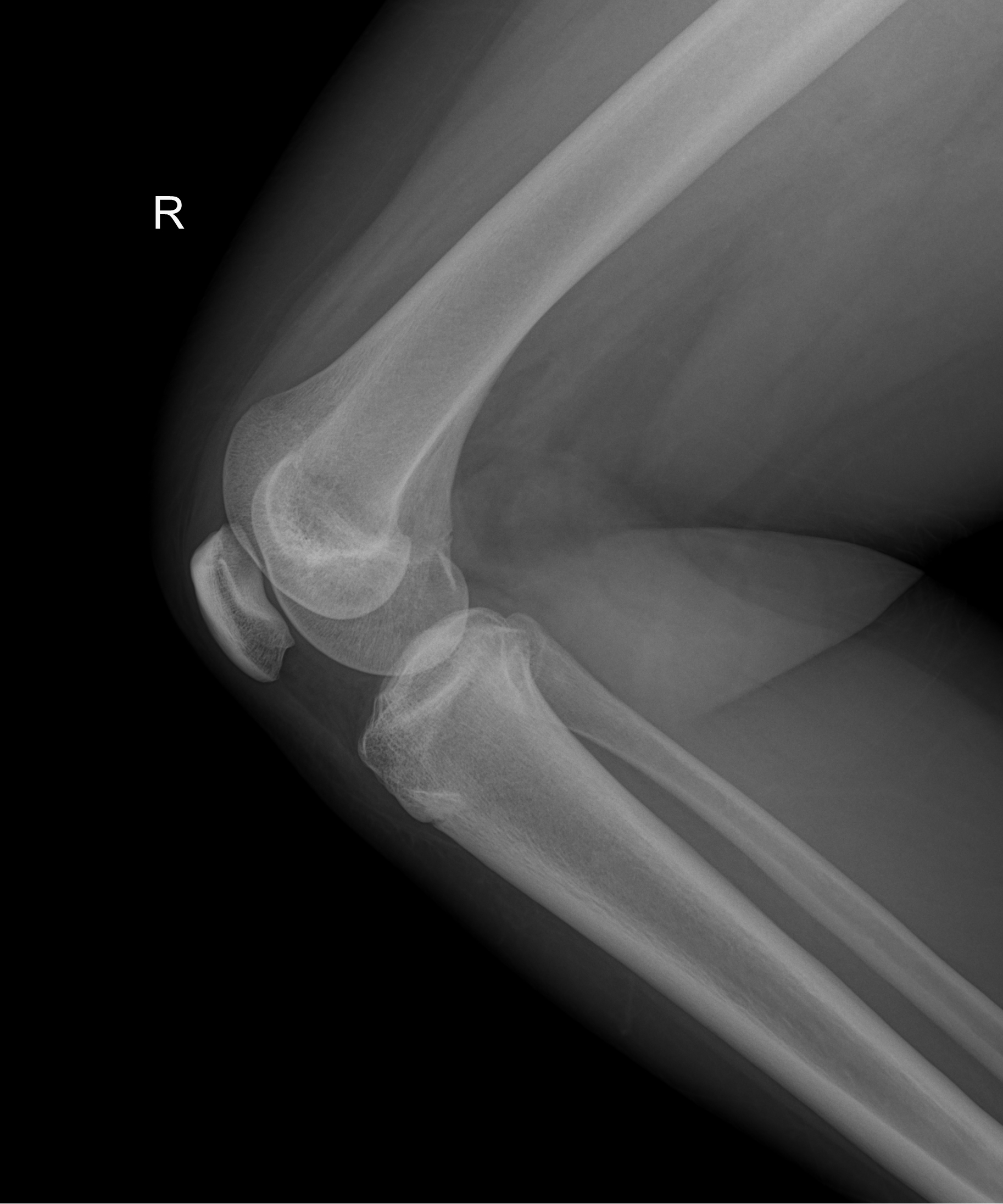 Bipartite patella | Image | Radiopaedia.org