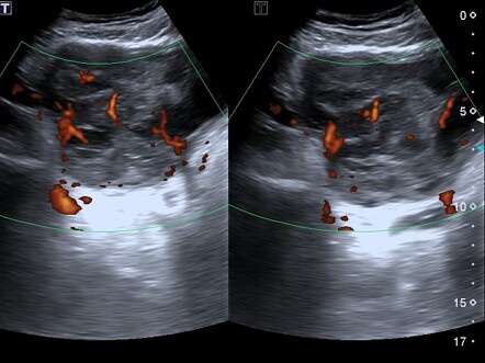 Prostate Cancer (ultrasound) | Image | Radiopaedia.org