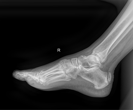 Achilles tendon ossification | Radiology Case | Radiopaedia.org