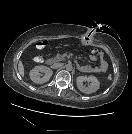 Buried Bumper Syndrome | Image | Radiopaedia.org