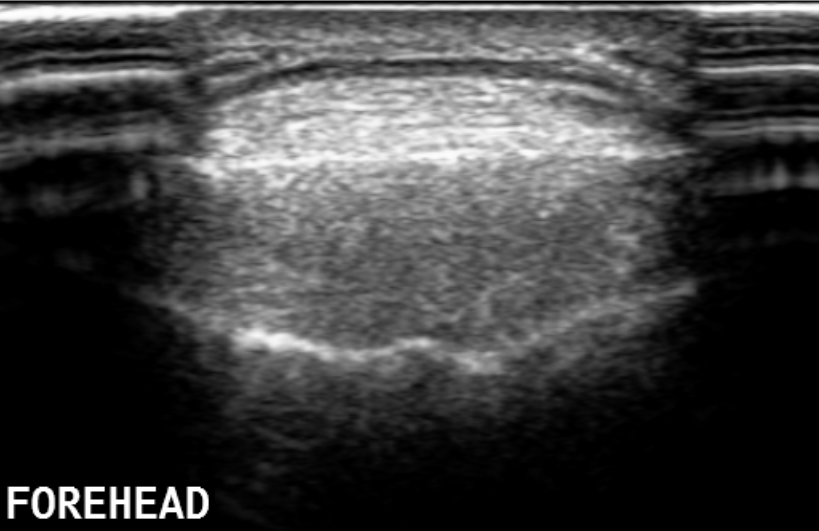 Subgaleal Lipoma Image