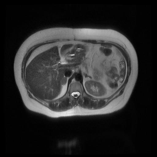 Adrenal adenoma | Image | Radiopaedia.org